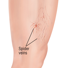 Sclerotherapy treats leg spider veins